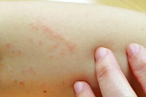 ความไวต่อการกระตุ้นอาการแพ้ทางผิวหนัง, Skin sensitization